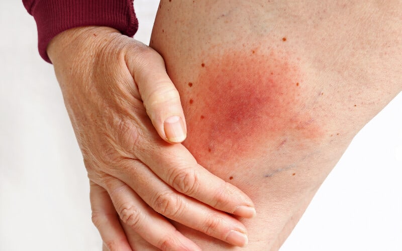 A rash on a woman's leg caused by Lyme disease.