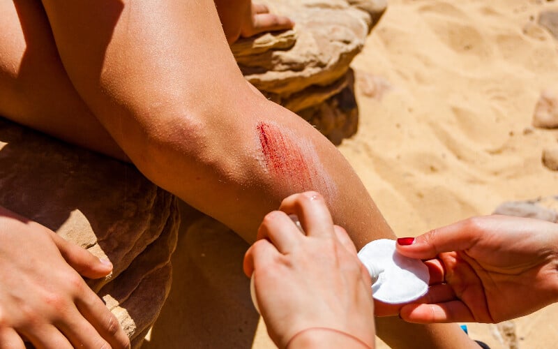 Close up of a person pouring sanitizer on a pad to clean a scraped leg.